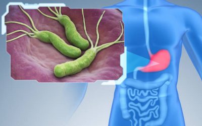 Helicobacter pylori es la principal causa de enfermedad gástrica: Cuáles son sus síntomas, cómo se transmite y cuándo debe investigarse si lo tienes